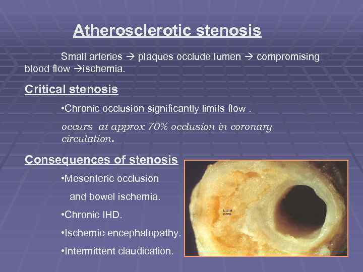 Atherosclerotic stenosis Small arteries plaques occlude lumen compromising blood flow ischemia. Critical stenosis •