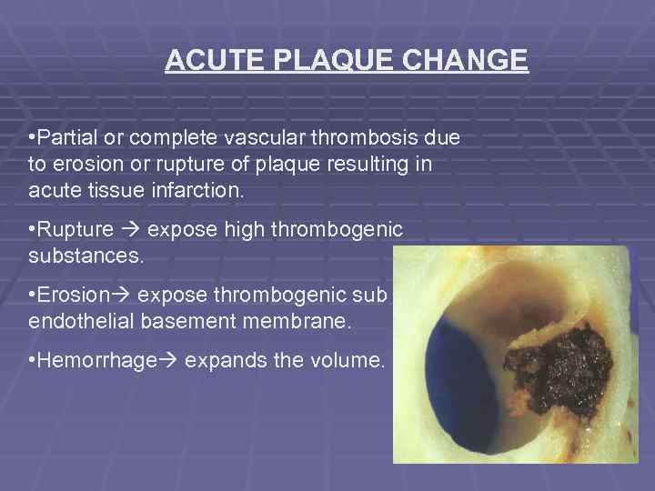 ACUTE PLAQUE CHANGE • Partial or complete vascular thrombosis due to erosion or rupture