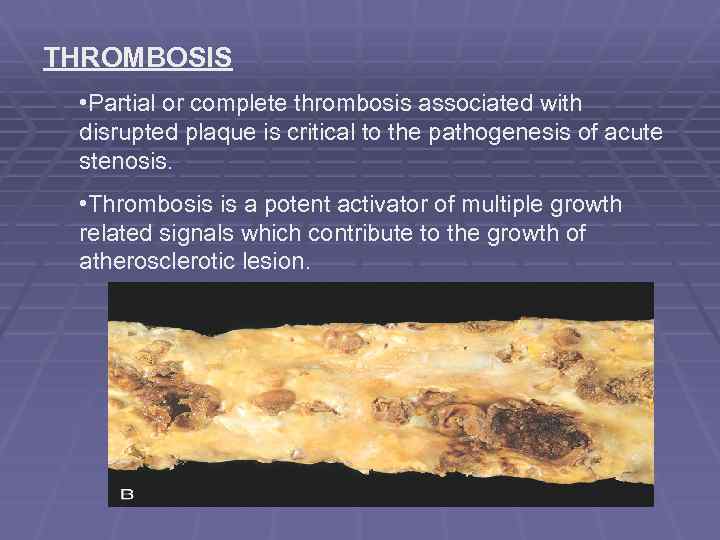 THROMBOSIS • Partial or complete thrombosis associated with disrupted plaque is critical to the