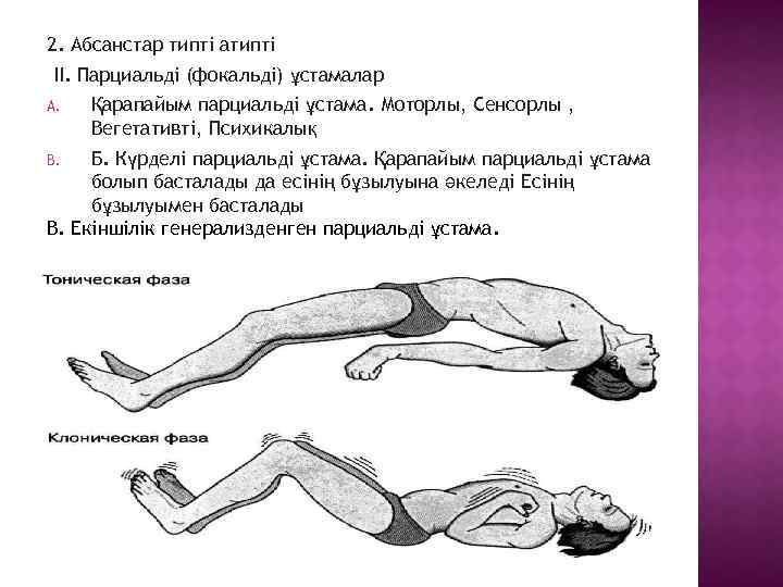 2. Абсанстар типті атипті II. Парциальді (фокальді) ұстамалар A. Қарапайым парциальді ұстама. Моторлы, Сенсорлы