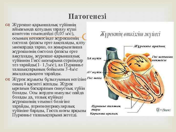  Патогенезі Жүрекше-қарыншалық түйіннің аймағында қозудың таралу күші кенеттен төмендейді (0, 05 мс), осының