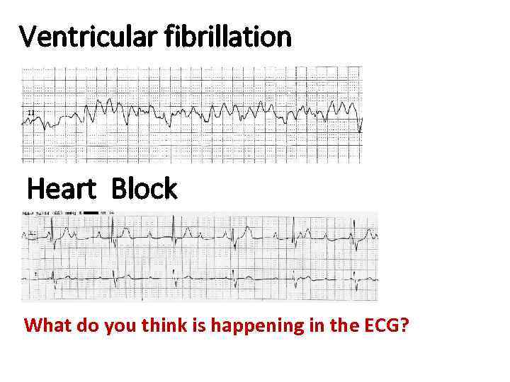 Ventricular fibrillation Heart Block What do you think is happening in the ECG? 