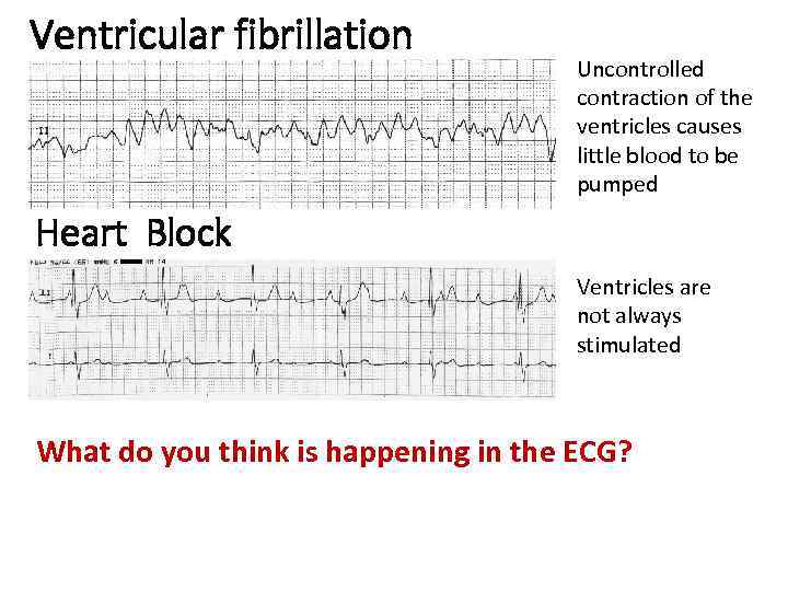 Ventricular fibrillation Uncontrolled contraction of the ventricles causes little blood to be pumped Heart