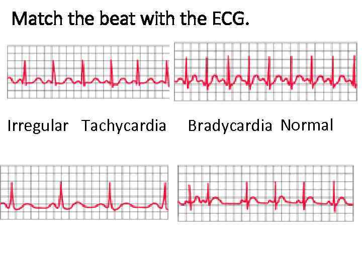 Match the beat with the ECG. Irregular Tachycardia Bradycardia Normal 