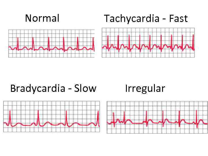 Normal Bradycardia - Slow Tachycardia - Fast Irregular 