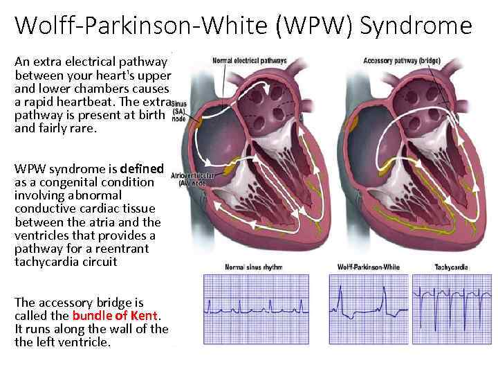 Wolff-Parkinson-White (WPW) Syndrome An extra electrical pathway between your heart's upper and lower chambers