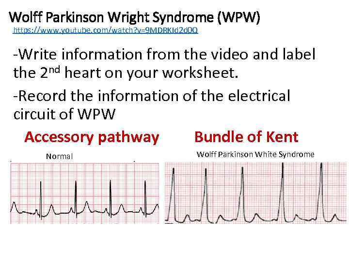 Wolff Parkinson Wright Syndrome (WPW) https: //www. youtube. com/watch? v=9 MDRKId 2 d 0