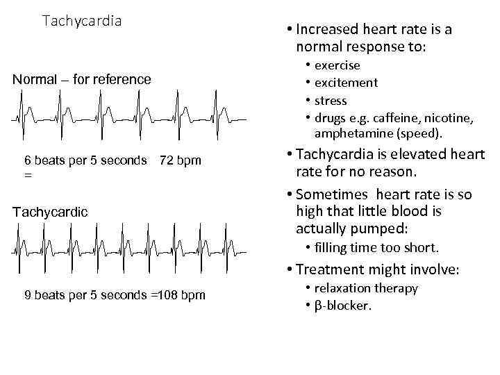Tachycardia Normal – for reference 6 beats per 5 seconds 72 bpm = Tachycardic