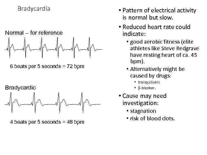 Bradycardia Normal – for reference 6 beats per 5 seconds = 72 bpm Bradycardic