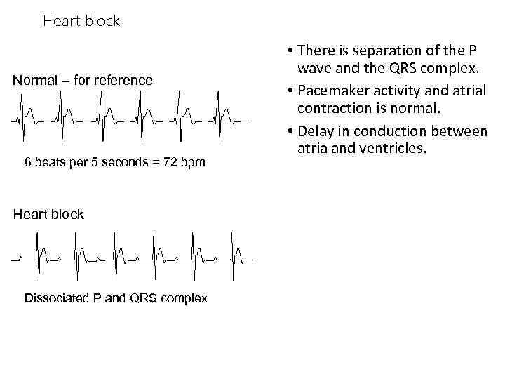 Heart block Normal – for reference 6 beats per 5 seconds = 72 bpm