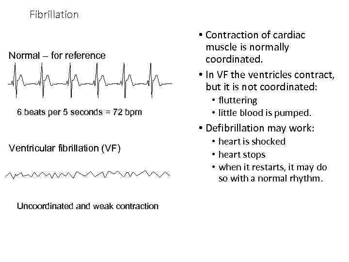 Fibrillation Normal – for reference 6 beats per 5 seconds = 72 bpm •