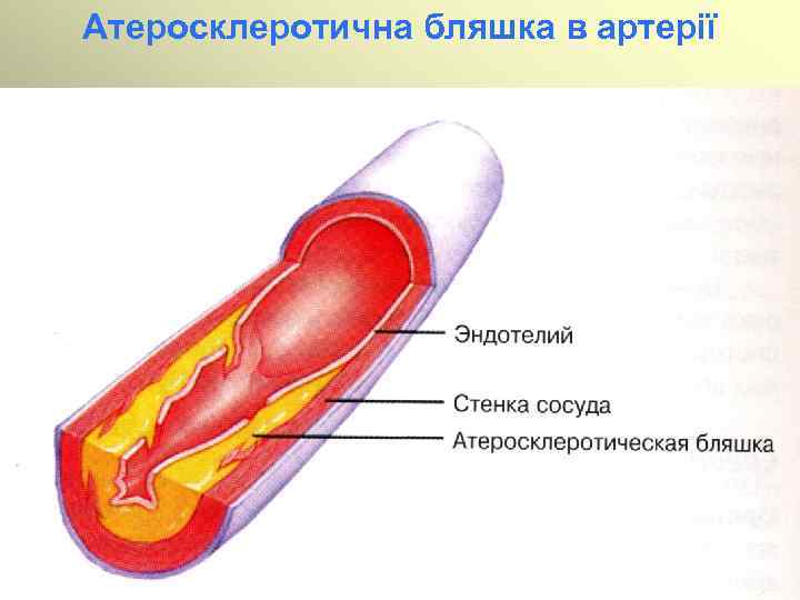 Атеросклеротична бляшка в артерії 
