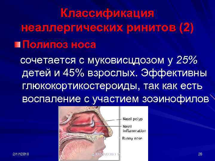 Классификация неаллергических ринитов (2) Полипоз носа сочетается с муковисцдозом у 25% детей и 45%