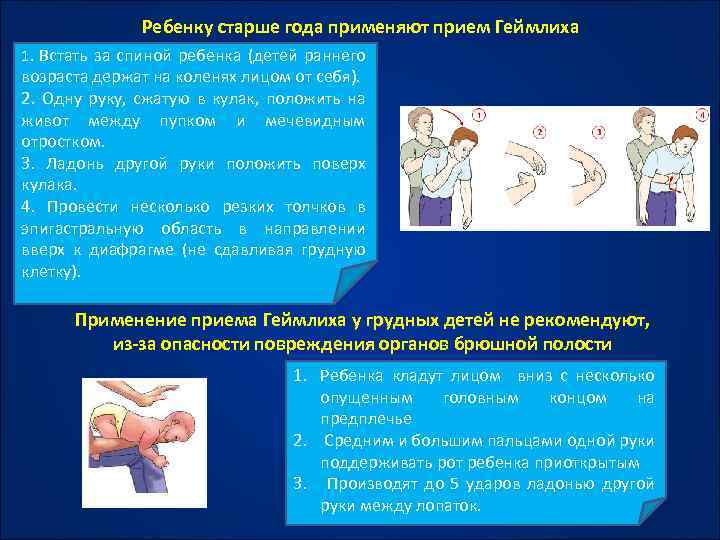 Ребенку старше года применяют прием Геймлиха 1. Встать за спиной ребенка (детей раннего возраста