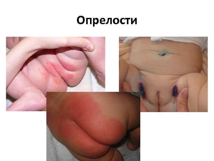 Опрелости 