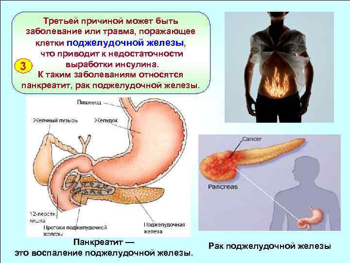 Третьей причиной может быть заболевание или травма, поражающее клетки поджелудочной железы, что приводит к