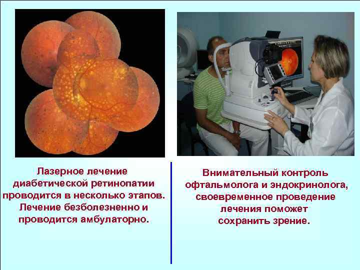 Лазерное лечение диабетической ретинопатии проводится в несколько этапов. Лечение безболезненно и проводится амбулаторно. Внимательный