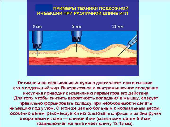 Оптимальное всасывание инсулина достигается при инъекции его в подкожный жир. Внутрикожное и внутримышечное попадание