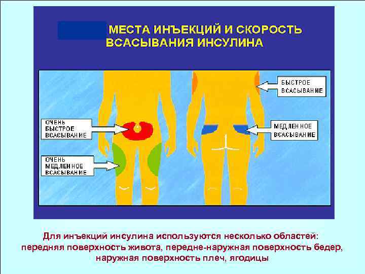 Для инъекций инсулина используются несколько областей: передняя поверхность живота, передне-наружная поверхность бедер, наружная поверхность