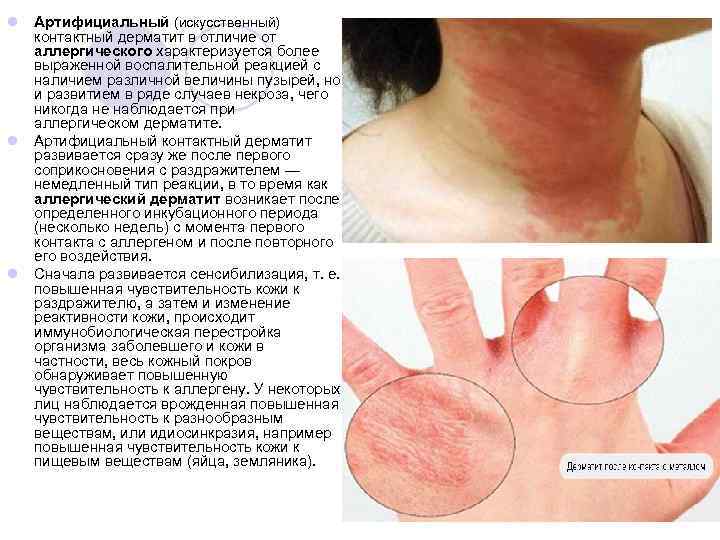 l Артифициальный (искусственный) контактный дерматит в отличие от аллергического характеризуется более выраженной воспалительной реакцией