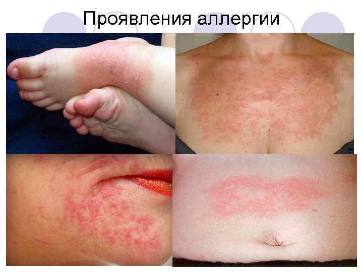 Проявления аллергии 