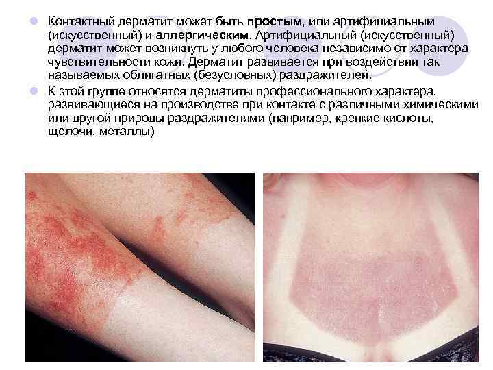 l Контактный дерматит может быть простым, или артифициальным (искусственный) и аллергическим. Артифициальный (искусственный) дерматит