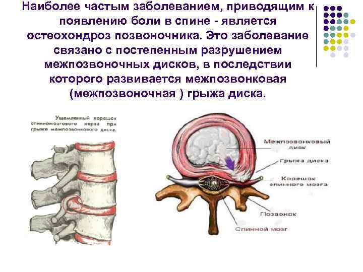 Наиболее частым заболеванием, приводящим к появлению боли в спине - является остеохондроз позвоночника. Это