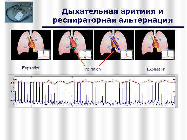 Дыхательная аритмия и респираторная альтернация Expiration Inpiration Expiration 