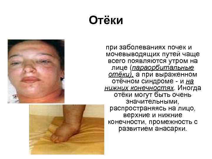 Отёки при заболеваниях почек и мочевыводящих путей чаще всего появляются утром на лице (параорбитальные