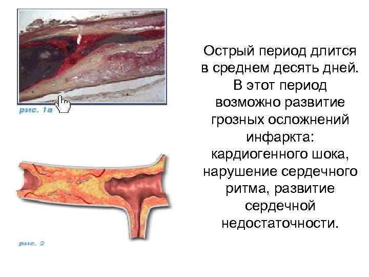 Острый период длится в среднем десять дней. В этот период возможно развитие грозных осложнений