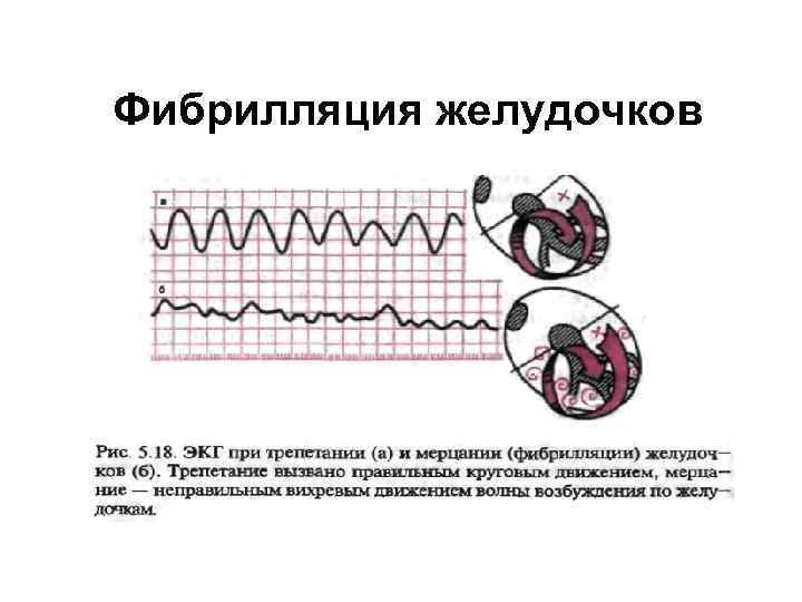 Фибрилляция желудочков 