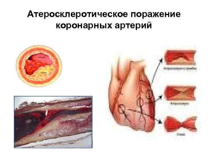 Атеросклеротическое поражение коронарных артерий 