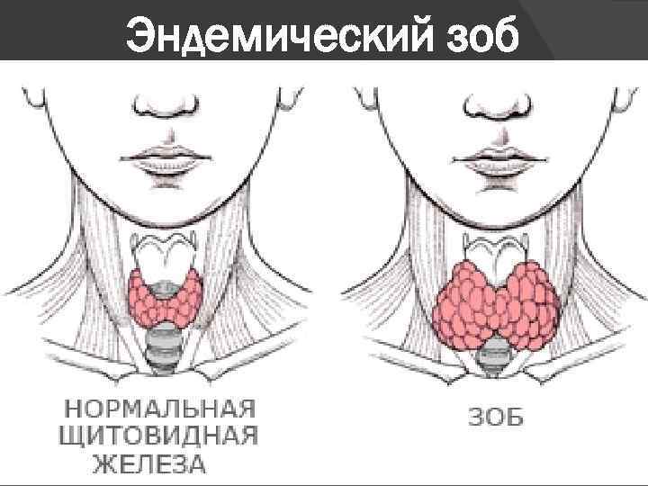 Эндемический зоб 