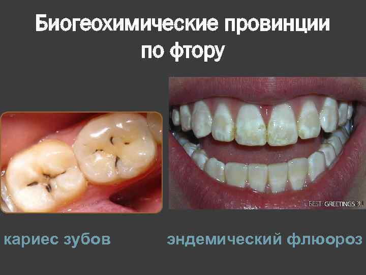 Биогеохимические провинции по фтору кариес зубов эндемический флюороз 