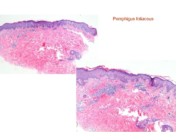  Pemphigus foliaceus 