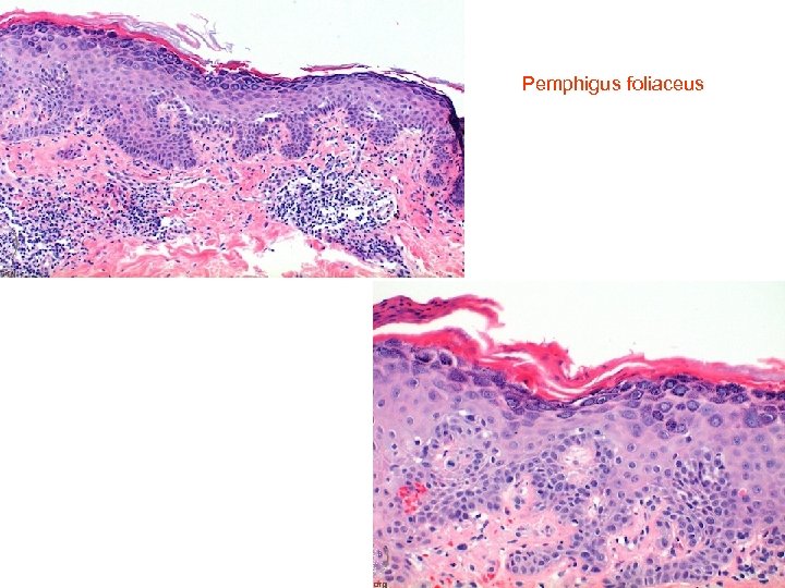  Pemphigus foliaceus 