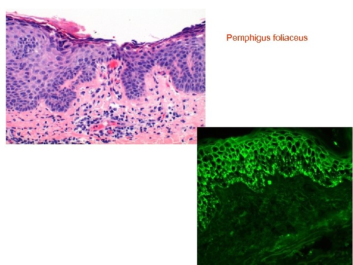  Pemphigus foliaceus 