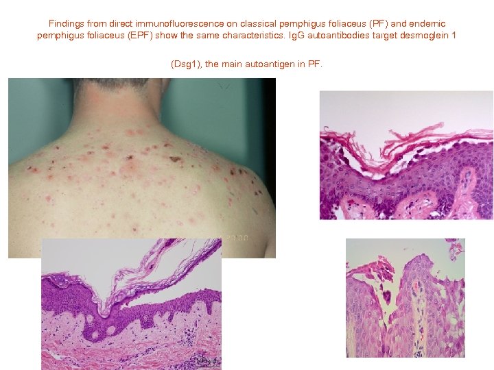 Findings from direct immunofluorescence on classical pemphigus foliaceus (PF) and endemic pemphigus foliaceus (EPF)