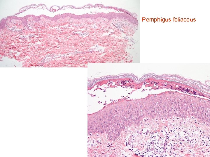  Pemphigus foliaceus 