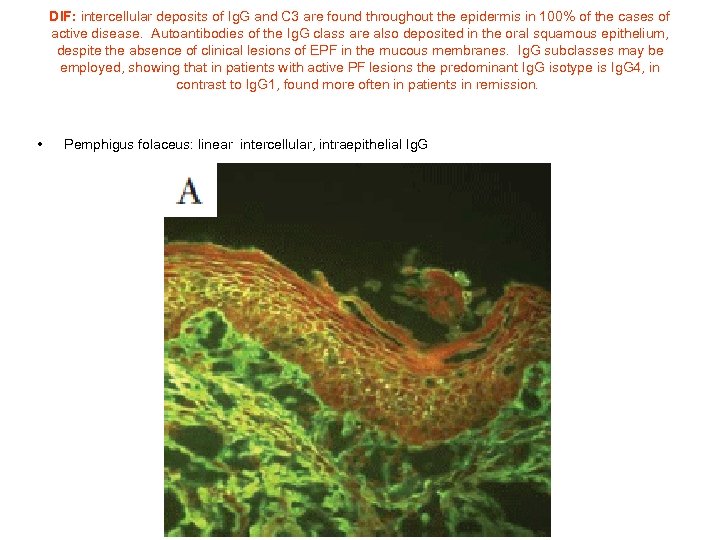 DIF: intercellular deposits of Ig. G and C 3 are found throughout the epidermis