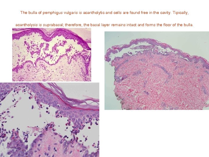 The bulla of pemphigus vulgaris is acantholytic and cells are found free in the