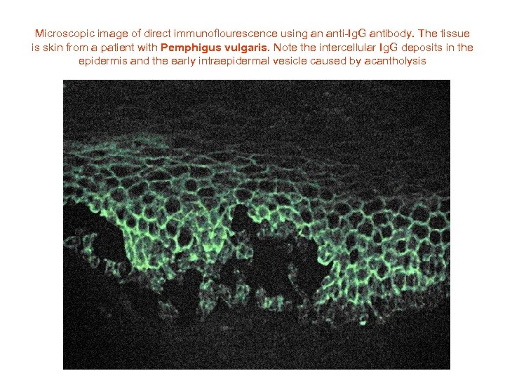 Microscopic image of direct immunoflourescence using an anti-Ig. G antibody. The tissue is skin