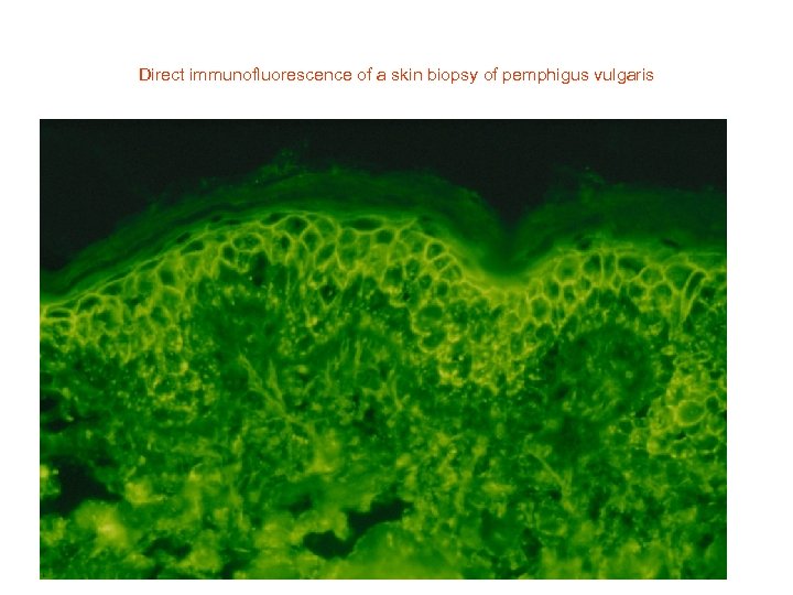 Direct immunofluorescence of a skin biopsy of pemphigus vulgaris 