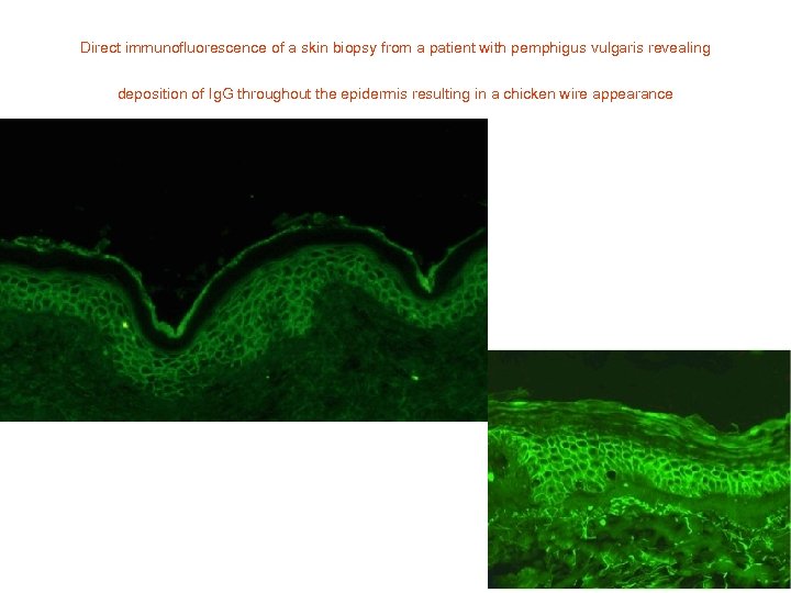 Direct immunofluorescence of a skin biopsy from a patient with pemphigus vulgaris revealing deposition