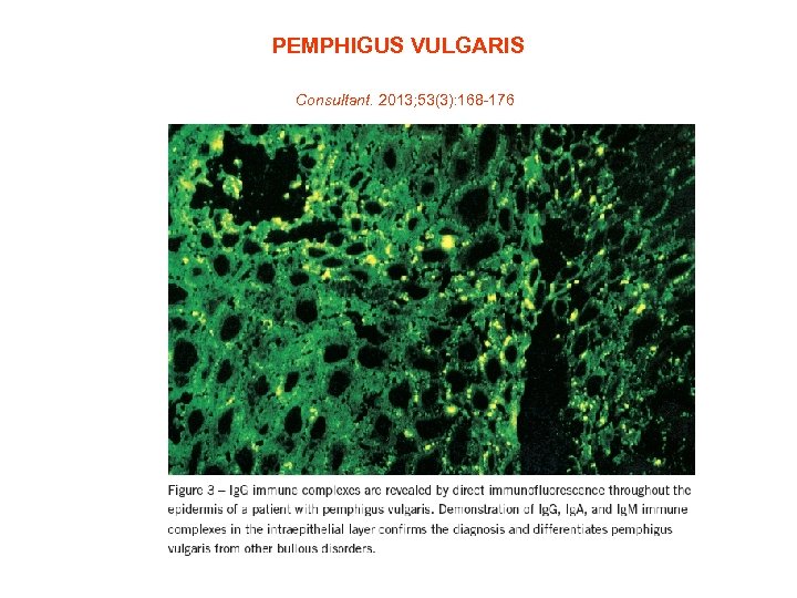 PEMPHIGUS VULGARIS Consultant. 2013; 53(3): 168 -176 