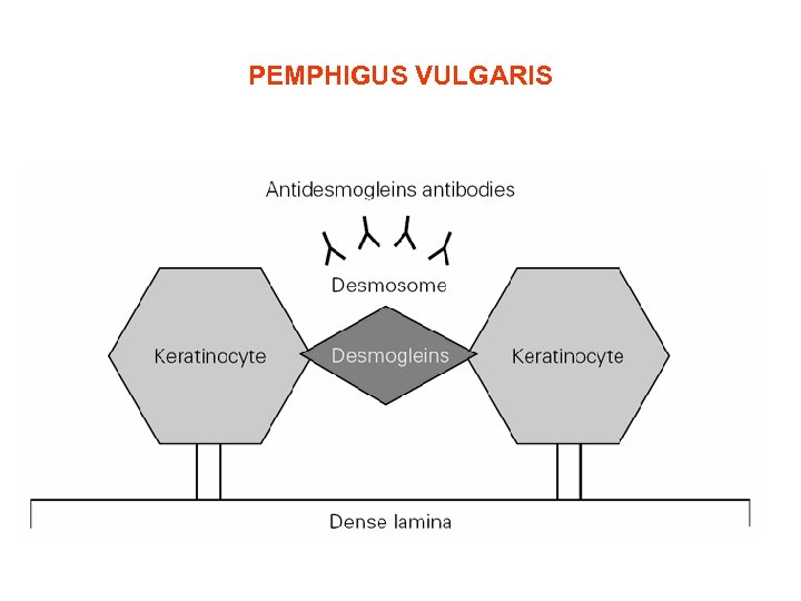 PEMPHIGUS VULGARIS 