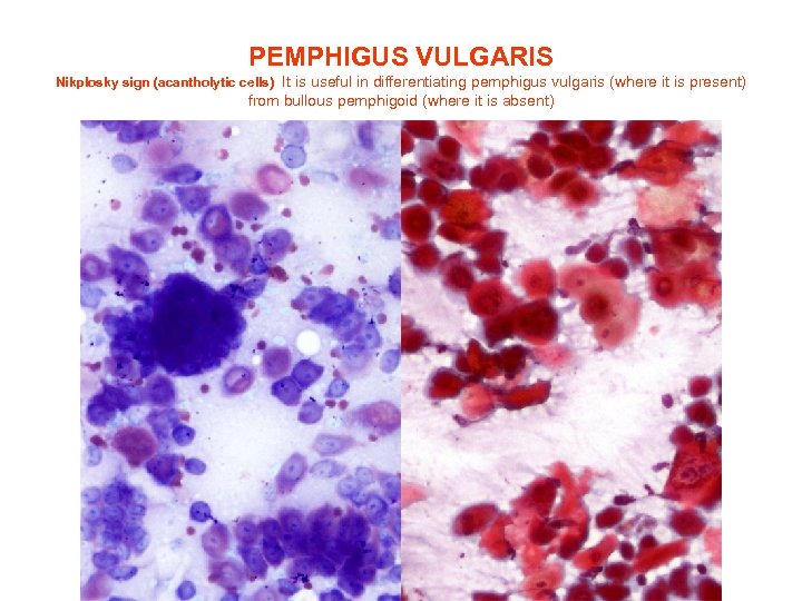 PEMPHIGUS VULGARIS Nikplosky sign (acantholytic cells) It is useful in differentiating pemphigus vulgaris (where