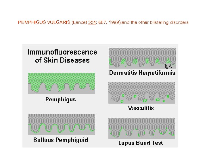 PEMPHIGUS VULGARIS (Lancet 354: 667, 1999) and the other blistering disorders 