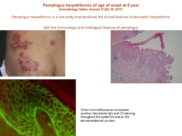 Pemphigus herpetiformis of age of onset at 6 year Dermatology Online Journal 17 (6):