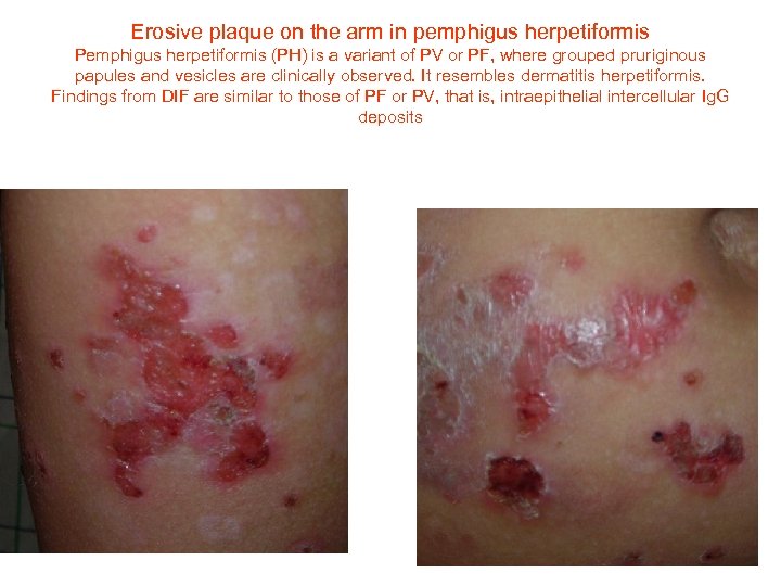 Erosive plaque on the arm in pemphigus herpetiformis Pemphigus herpetiformis (PH) is a variant